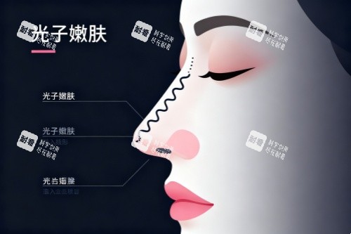 面部做光子嫩肤卡通图.jpg 面部做光子嫩肤卡通图.jpg
